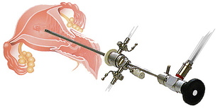 Фото: Гистерорезектоскопия