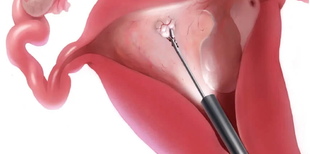 Фото: Особенности проведения гистерорезектоскопии