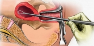 Фото: Гистероскопия с выскабливанием - отзывы