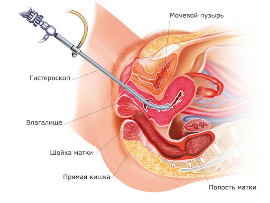 Фото: Выполнение процедуры гистероскопии