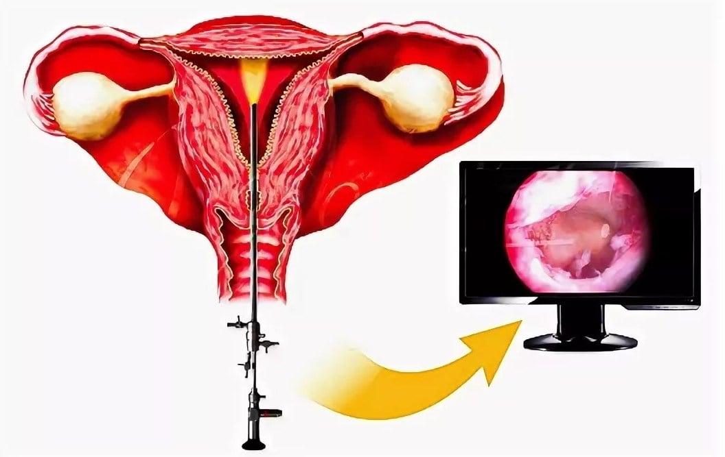 Фото: Что показывает гистероскопия