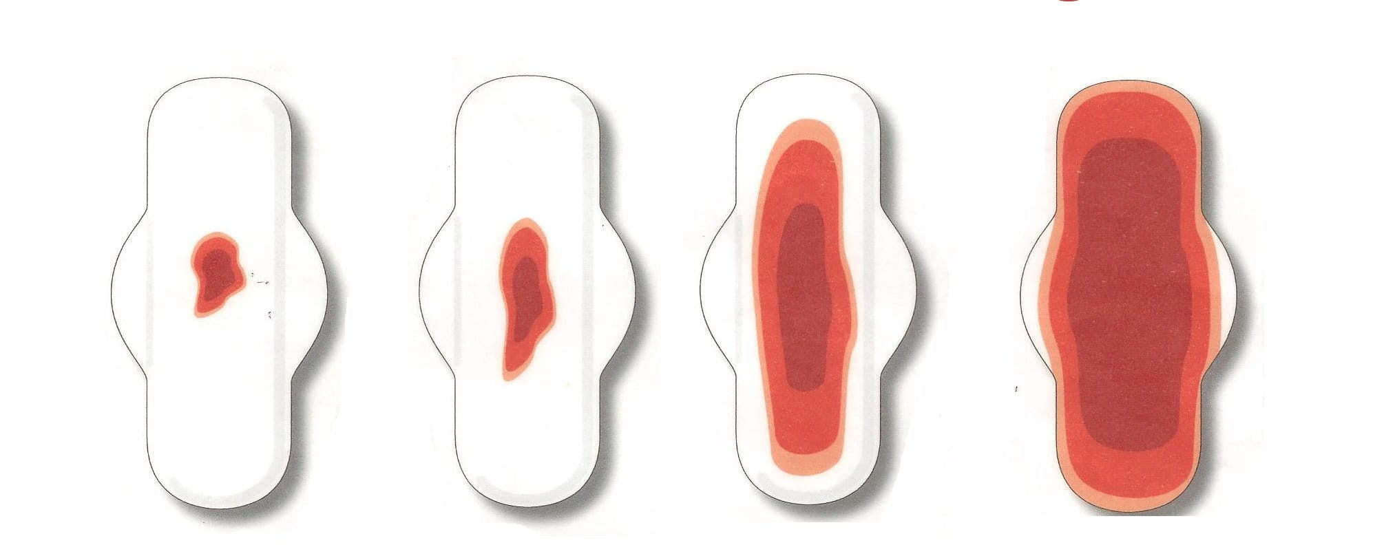 Фото: Выделения после гистероскопии